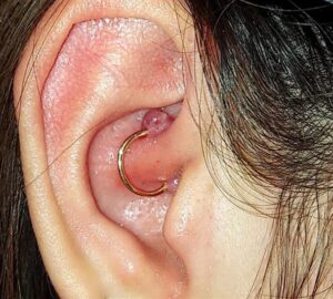 Why You are Getting a Piercing Bump